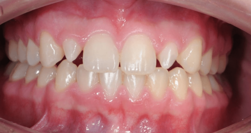 Denti Piccoli: Cause, Trattamenti e Soluzioni Estetiche