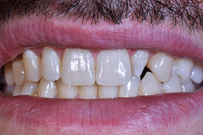 Dettaglio dei denti piccoli di un ragazzo in primo piano